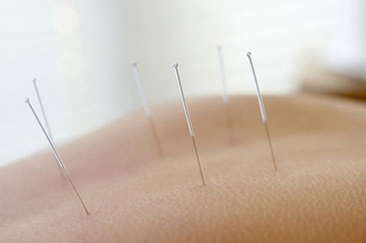 Waarom kiezen voor acupunctuur?